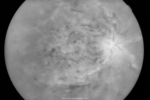 49-year-old woman has central retinal vein occlusion right eye with fluctuating vision for a few month now with  OD 20/100.  IOP: OD 20
