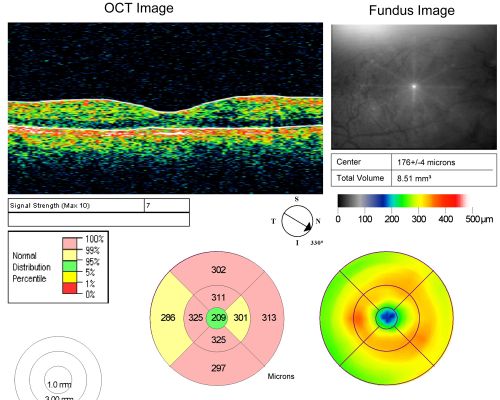 49-year-old woman has central retinal vein occlusion right eye with fluctuating vision for a few month now with  OD 20/100.  IOP: OD 20
