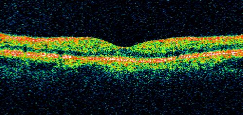 49-year-old woman has central retinal vein occlusion right eye with fluctuating vision for a few month now with  OD 20/100.  IOP: OD 20
