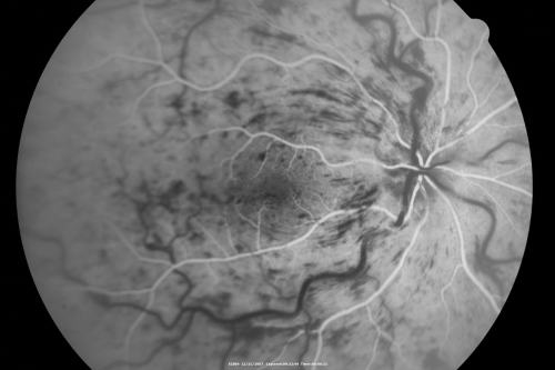 49-year-old woman has central retinal vein occlusion right eye with fluctuating vision for a few month now with  OD 20/100.  IOP: OD 20
