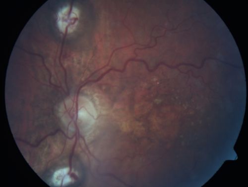 Central Retinal Vein Occlusion and Laser Induced Chorioretinal Anastomosis
84-year-old woman has age-related macular degeneration in both eyes with foveal atrophy.  She also has a central retinal vein occlusion 
in the left eye for which she had intravitreal Kenalog and finally chorioretinal anastomosis laser a year 
ago.  VISUAL ACUITY:  Vision OD is 20/160, OS is 7/200

