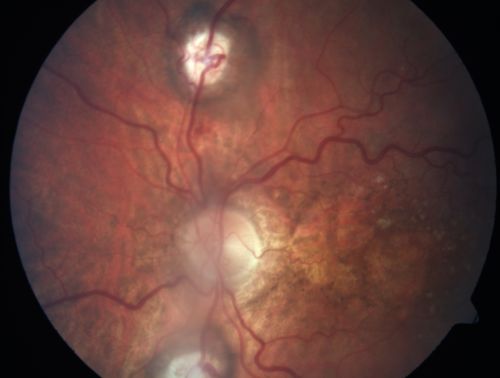 Central Retinal Vein Occlusion and Laser Induced Chorioretinal Anastomosis
84-year-old woman has age-related macular degeneration in both eyes with foveal atrophy.  She also has a central retinal vein occlusion 
in the left eye for which she had intravitreal Kenalog and finally chorioretinal anastomosis laser a year 
ago.  VISUAL ACUITY:  Vision OD is 20/160, OS is 7/200
