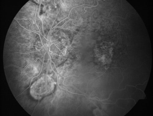 Central Retinal Vein Occlusion and Laser Induced Chorioretinal Anastomosis
84-year-old woman has age-related macular degeneration in both eyes with foveal atrophy.  She also has a central retinal vein occlusion 
in the left eye for which she had intravitreal Kenalog and finally chorioretinal anastomosis laser a year 
ago.  VISUAL ACUITY:  Vision OD is 20/160, OS is 7/200
