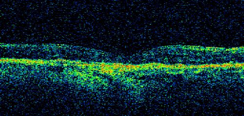 Central Retinal Vein Occlusion and Laser Induced Chorioretinal Anastomosis
84-year-old woman has age-related macular degeneration in both eyes with foveal atrophy.  She also has a central retinal vein occlusion 
in the left eye for which she had intravitreal Kenalog and finally chorioretinal anastomosis laser a year 
ago.  VISUAL ACUITY:  Vision OD is 20/160, OS is 7/200
