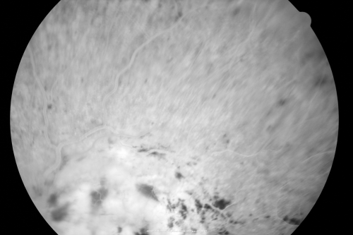 Central Retinal Vein Occlusion - New- and old Macular Scar from AMD
87-year-old woman with longstaning macular scars and new vision loss left eye for 2 months. OD:  20/200, OS 20/400. 
