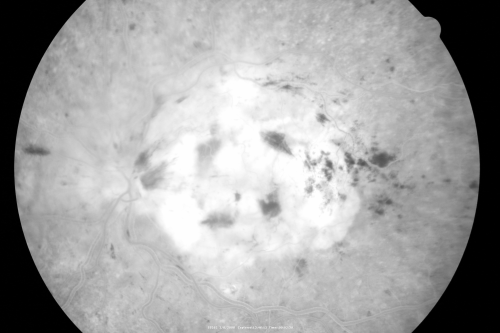 Central Retinal Vein Occlusion - New- and old Macular Scar from AMD
87-year-old woman with longstaning macular scars and new vision loss left eye for 2 months. OD:  20/200, OS 20/400. 
