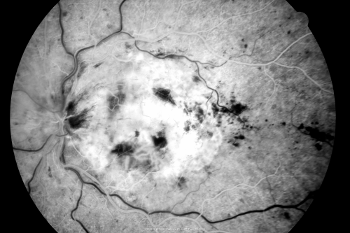 Central Retinal Vein Occlusion - New- and old Macular Scar from AMD
87-year-old woman with longstaning macular scars and new vision loss left eye for 2 months. OD:  20/200, OS 20/400. 
