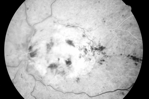 Central Retinal Vein Occlusion - New- and old Macular Scar from AMD
87-year-old woman with longstaning macular scars and new vision loss left eye for 2 months. OD:  20/200, OS 20/400. 
