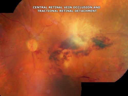 Central Retinal Vein Occlusion and Tractional Retinal Detachment for 3 Years (Patient is Diabetic)
67-year-old woman has severe vision loss in the left eye for 3 years  OD 20/32,  OS 3/200
