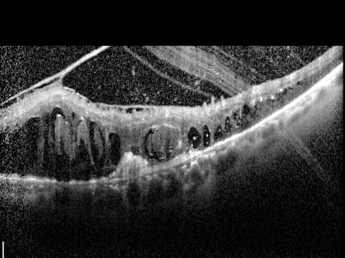 Central Retinal Vein Occlusion and Tractional Retinal Detachment for 3 Years (Patient is Diabetic)
67-year-old woman has severe vision loss in the left eye for 3 years  OD 20/32,  OS 3/200
