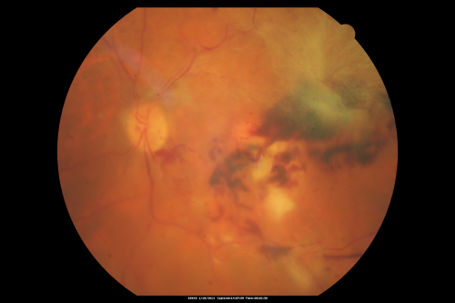 Central Retinal Vein Occlusion and Tractional Retinal Detachment for 3 Years (Patient is Diabetic)
67-year-old woman has severe vision loss in the left eye for 3 years  OD 20/32,  OS 3/200
