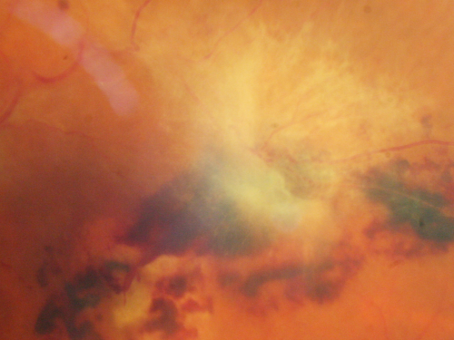 Central Retinal Vein Occlusion and Tractional Retinal Detachment for 3 Years (Patient is Diabetic)
67-year-old woman has severe vision loss in the left eye for 3 years  OD 20/32,  OS 3/200
