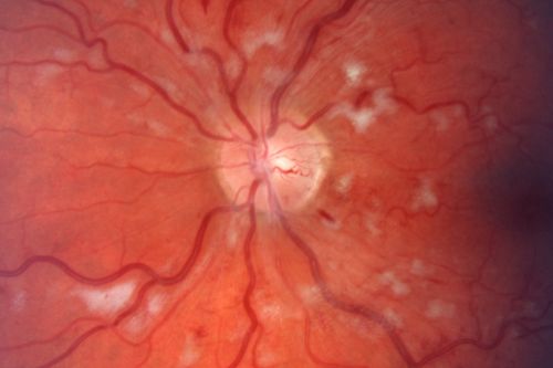 Non-Ischemic Central Retinal Vein Occlusion in Young Man (30 years) - Many Cotton Wool Spots
30-year-old man with a history of a central retinal vein occlusion for which he was first examined on 2 months ago and his vision then was 4/200.  He responded nicely to two Avastin treatments. OD is 20/20, OS is 20/60
