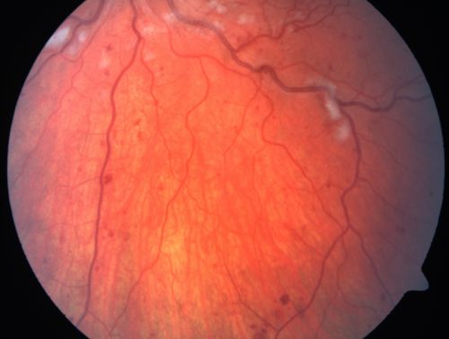 Non-Ischemic Central Retinal Vein Occlusion in Young Man (30 years) - Many Cotton Wool Spots
30-year-old man with a history of a central retinal vein occlusion for which he was first examined on 2 months ago and his vision then was 4/200.  He responded nicely to two Avastin treatments. OD is 20/20, OS is 20/60
