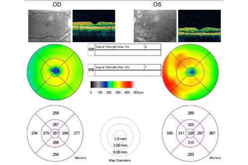 Non-Ischemic Central Retinal Vein Occlusion in Young Man (30 years) - Many Cotton Wool Spots
30-year-old man with a history of a central retinal vein occlusion for which he was first examined on 2 months ago and his vision then was 4/200.  He responded nicely to two Avastin treatments. OD is 20/20, OS is 20/60

