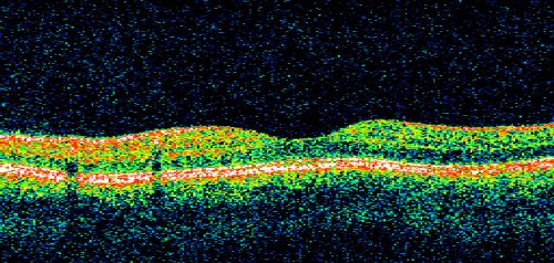Non-Ischemic Central Retinal Vein Occlusion in Young Man (30 years) - Many Cotton Wool Spots
30-year-old man with a history of a central retinal vein occlusion for which he was first examined on 2 months ago and his vision then was 4/200.  He responded nicely to two Avastin treatments. OD is 20/20, OS is 20/60
