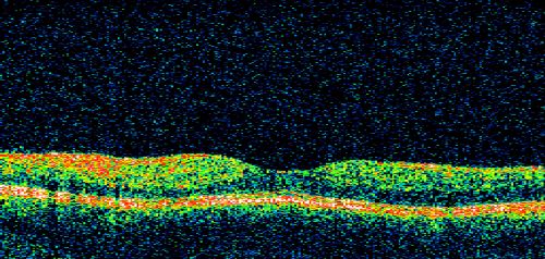 Non-Ischemic Central Retinal Vein Occlusion in Young Man (30 years) - Many Cotton Wool Spots
30-year-old man with a history of a central retinal vein occlusion for which he was first examined on 2 months ago and his vision then was 4/200.  He responded nicely to two Avastin treatments. OD is 20/20, OS is 20/60
