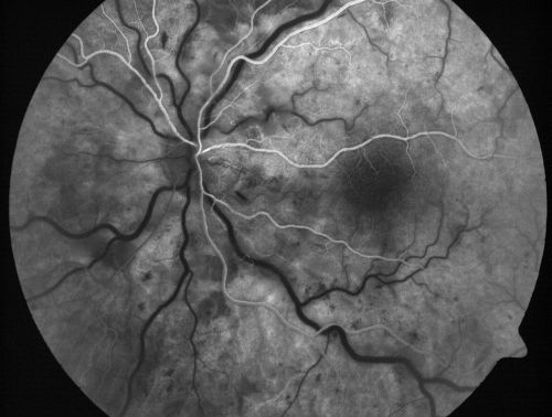 Non-Ischemic Central Retinal Vein Occlusion in Young Man (30 years) - Many Cotton Wool Spots
30-year-old man with a history of a central retinal vein occlusion for which he was first examined on 2 months ago and his vision then was 4/200.  He responded nicely to two Avastin treatments. OD is 20/20, OS is 20/60
