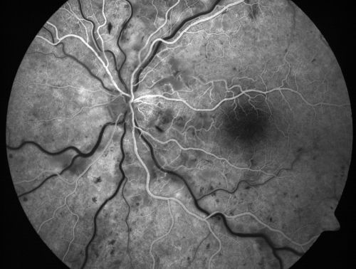 Non-Ischemic Central Retinal Vein Occlusion in Young Man (30 years) - Many Cotton Wool Spots
30-year-old man with a history of a central retinal vein occlusion for which he was first examined on 2 months ago and his vision then was 4/200.  He responded nicely to two Avastin treatments. OD is 20/20, OS is 20/60
