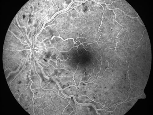 Non-Ischemic Central Retinal Vein Occlusion in Young Man (30 years) - Many Cotton Wool Spots
30-year-old man with a history of a central retinal vein occlusion for which he was first examined on 2 months ago and his vision then was 4/200.  He responded nicely to two Avastin treatments. OD is 20/20, OS is 20/60
