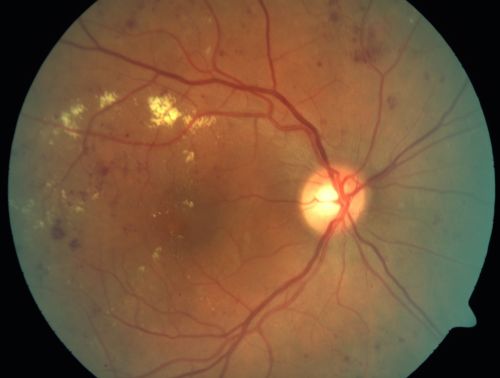 Clinically Significant Diabetic Macular Edema both Eyes with Exudates
56-year-old woman with diabetes for twelve years.  She has noticed blurring of the vision in the right eye for about six months.  OD is 20/70, OS is 20/25. 
