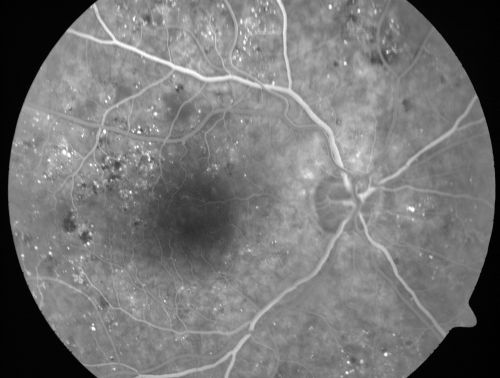 Clinically Significant Diabetic Macular Edema both Eyes with Exudates
56-year-old woman with diabetes for twelve years.  She has noticed blurring of the vision in the right eye for about six months.  OD is 20/70, OS is 20/25. 
