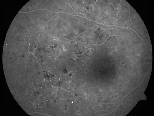 Clinically Significant Diabetic Macular Edema both Eyes with Exudates
56-year-old woman with diabetes for twelve years.  She has noticed blurring of the vision in the right eye for about six months.  OD is 20/70, OS is 20/25. 
