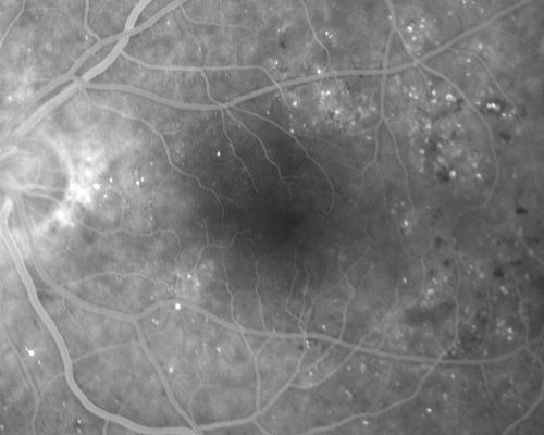 Clinically Significant Diabetic Macular Edema both Eyes with Exudates
56-year-old woman with diabetes for twelve years.  She has noticed blurring of the vision in the right eye for about six months.  OD is 20/70, OS is 20/25. 
