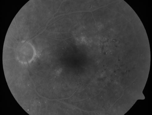 Clinically Significant Diabetic Macular Edema both Eyes with Exudates
56-year-old woman with diabetes for twelve years.  She has noticed blurring of the vision in the right eye for about six months.  OD is 20/70, OS is 20/25. 
