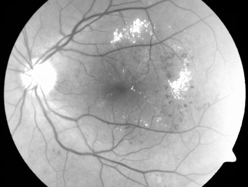 Clinically Significant Diabetic Macular Edema both Eyes with Exudates
56-year-old woman with diabetes for twelve years.  She has noticed blurring of the vision in the right eye for about six months.  OD is 20/70, OS is 20/25. 
