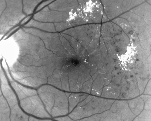Clinically Significant Diabetic Macular Edema both Eyes with Exudates
56-year-old woman with diabetes for twelve years.  She has noticed blurring of the vision in the right eye for about six months.  OD is 20/70, OS is 20/25. 
