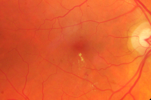 63-year-old man diabetic for twenty two years.  His central vision is fine. 

VISUAL ACUITY:  OD 20/25,  OS 20/25

