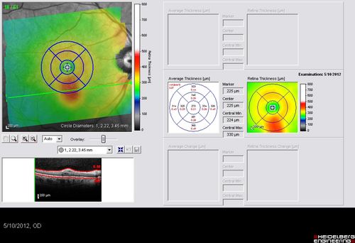 63-year-old man diabetic for twenty two years.  His central vision is fine. 

VISUAL ACUITY:  OD 20/25,  OS 20/25
