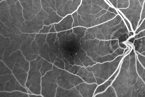 63-year-old man diabetic for twenty two years.  His central vision is fine. 

VISUAL ACUITY:  OD 20/25,  OS 20/25
