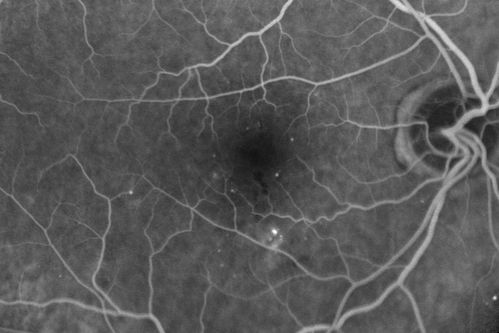 63-year-old man diabetic for twenty two years.  His central vision is fine. 

VISUAL ACUITY:  OD 20/25,  OS 20/25
