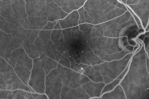Diabetic Macular Edema - Mild
70 year old man with mild edema did well without treatment
