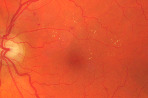 63-year-old man diabetic for twenty two years.  His central vision is fine. 

VISUAL ACUITY:  OD 20/25,  OS 20/25
