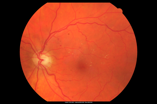 63-year-old man diabetic for twenty two years.  His central vision is fine. 

VISUAL ACUITY:  OD 20/25,  OS 20/25
