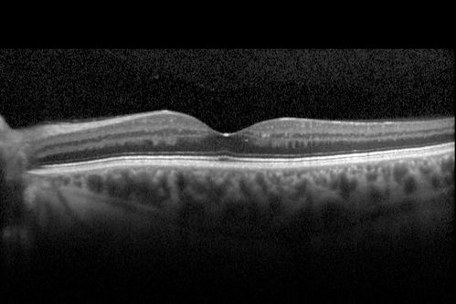 Diabetic Macular Edema - Mild
70 year old man with mild edema did well without treatment
