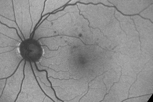 Diabetic Macular Edema - Mild
70 year old man with mild edema did well without treatment
