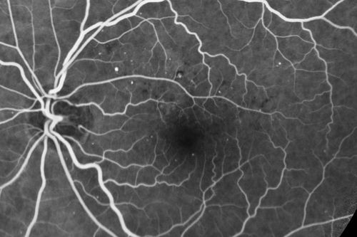 63-year-old man diabetic for twenty two years.  His central vision is fine. 

VISUAL ACUITY:  OD 20/25,  OS 20/25
