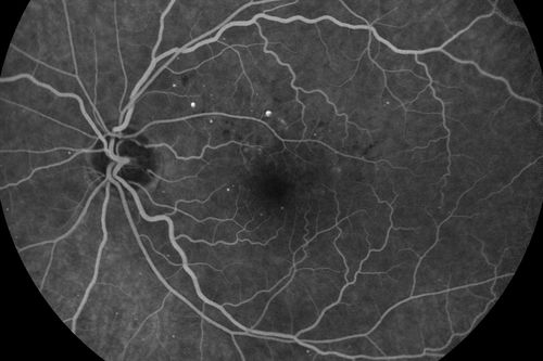 Diabetic Macular Edema - Mild
70 year old man with mild edema did well without treatment
