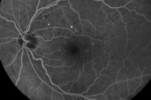 Diabetic Macular Edema - Mild
70 year old man with mild edema did well without treatment
