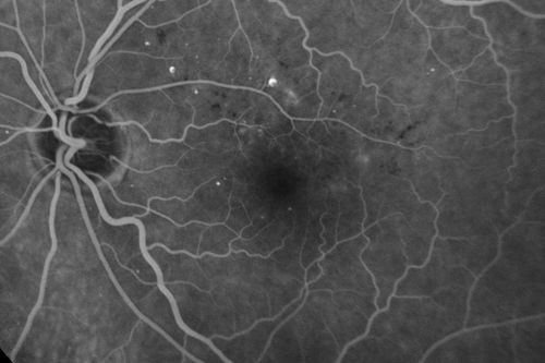 63-year-old man diabetic for twenty two years.  His central vision is fine. 

VISUAL ACUITY:  OD 20/25,  OS 20/25
