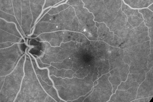 Diabetic Macular Edema - Mild
70 year old man with mild edema did well without treatment
