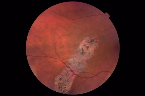 Normal Vision - Chronic Central Serous Chorioretinopathy
67 year old man - never had any symptoms - 20/16 vision in each eye.  Lesions spare the fovea
