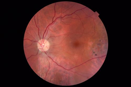 Normal Vision - Chronic Central Serous Chorioretinopathy
67 year old man - never had any symptoms - 20/16 vision in each eye.  Lesions spare the fovea
