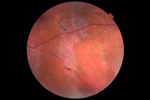 Normal Vision - Chronic Central Serous Chorioretinopathy
67 year old man - never had any symptoms - 20/16 vision in each eye.  Lesions spare the fovea
