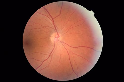 Central Serous Chorioretinopathy - Moderate
49 year old man with episodes in 2011, 2017, and 2018 - now with some paracentral vision loss in the right eye and subretinal fluid.
