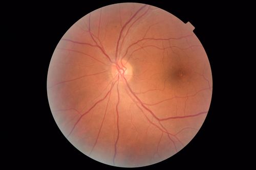 Central Serous Chorioretinopathy - Moderate
49 year old man with episodes in 2011, 2017, and 2018 - now with some paracentral vision loss in the right eye and subretinal fluid.
